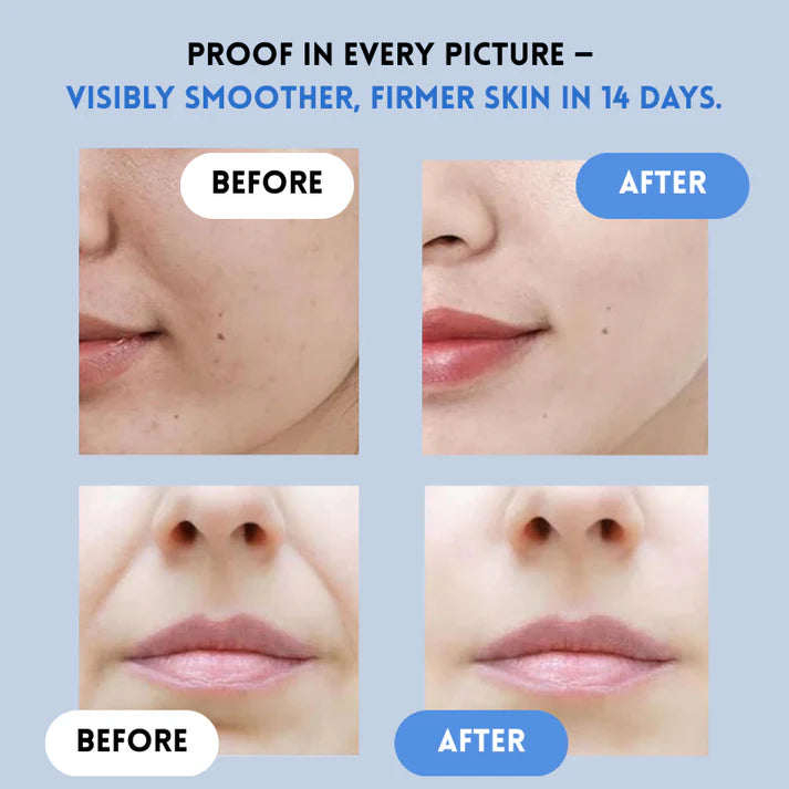 Auralift Renew Strips ✅Reduces wrinkles and improves skin firmness in 7 days