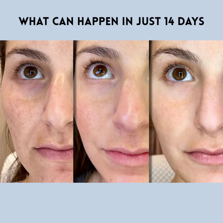 Auralift Renew Strips ✅Reduces wrinkles and improves skin firmness in 7 days