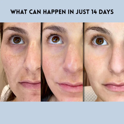 Auralift Renew Strips ✅Reduces wrinkles and improves skin firmness in 7 days