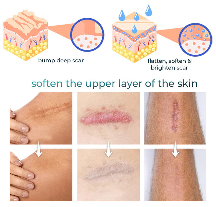 👩‍🔬Bioskin™ Advanced Scar and Stretch Marks Removal Gel✅ 7-Day Improvement Guarantee – Full Refund if No Results